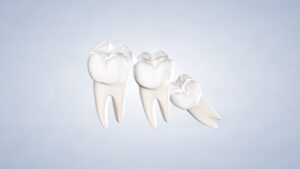 wisdom teeth removal procedure