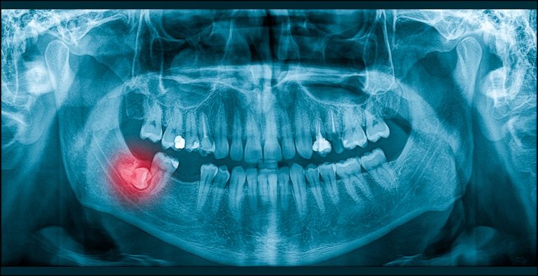 wisdom tooth pain