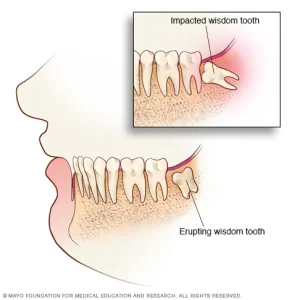 wisdom tooth pain